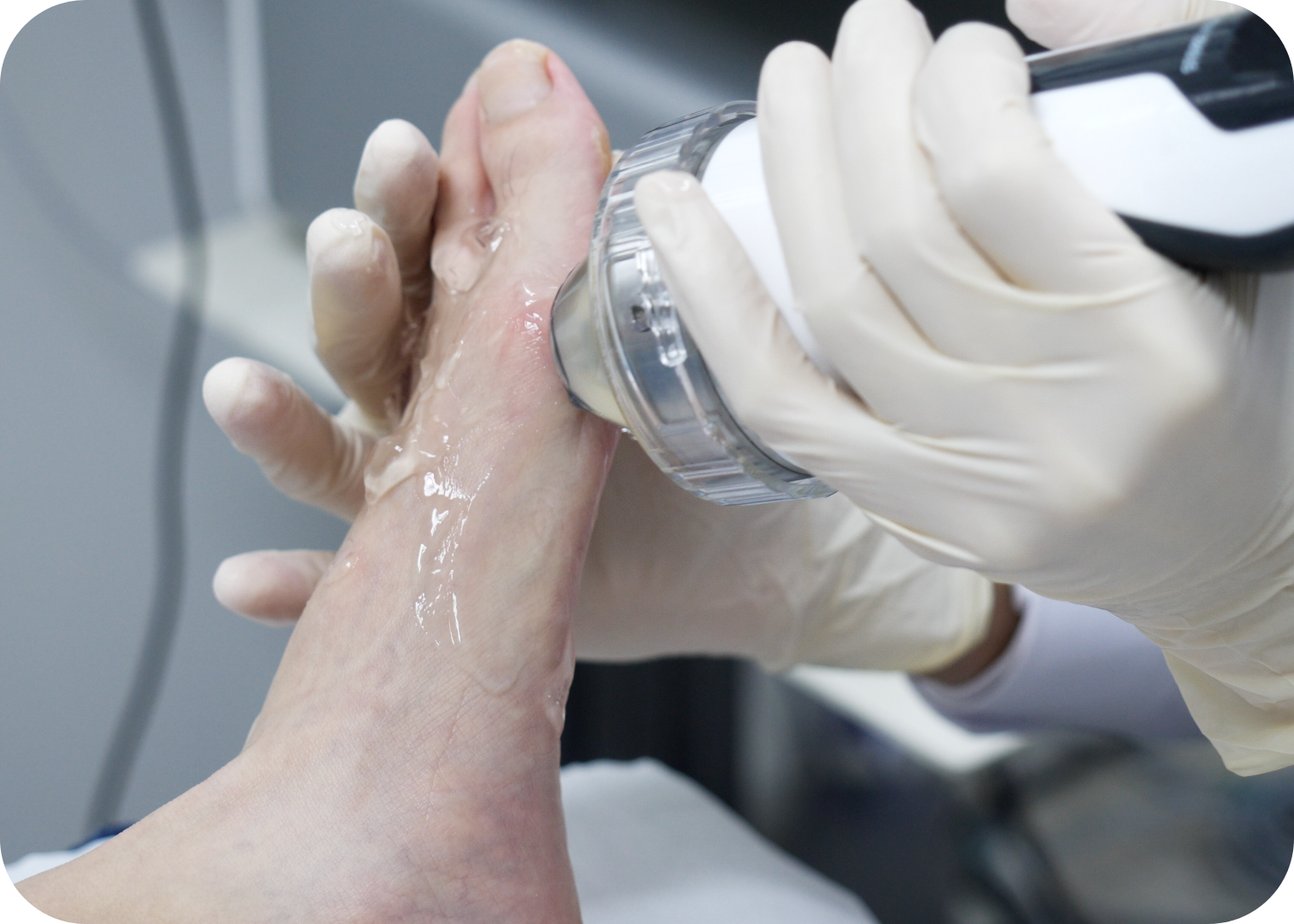 Bunion (Round edges)