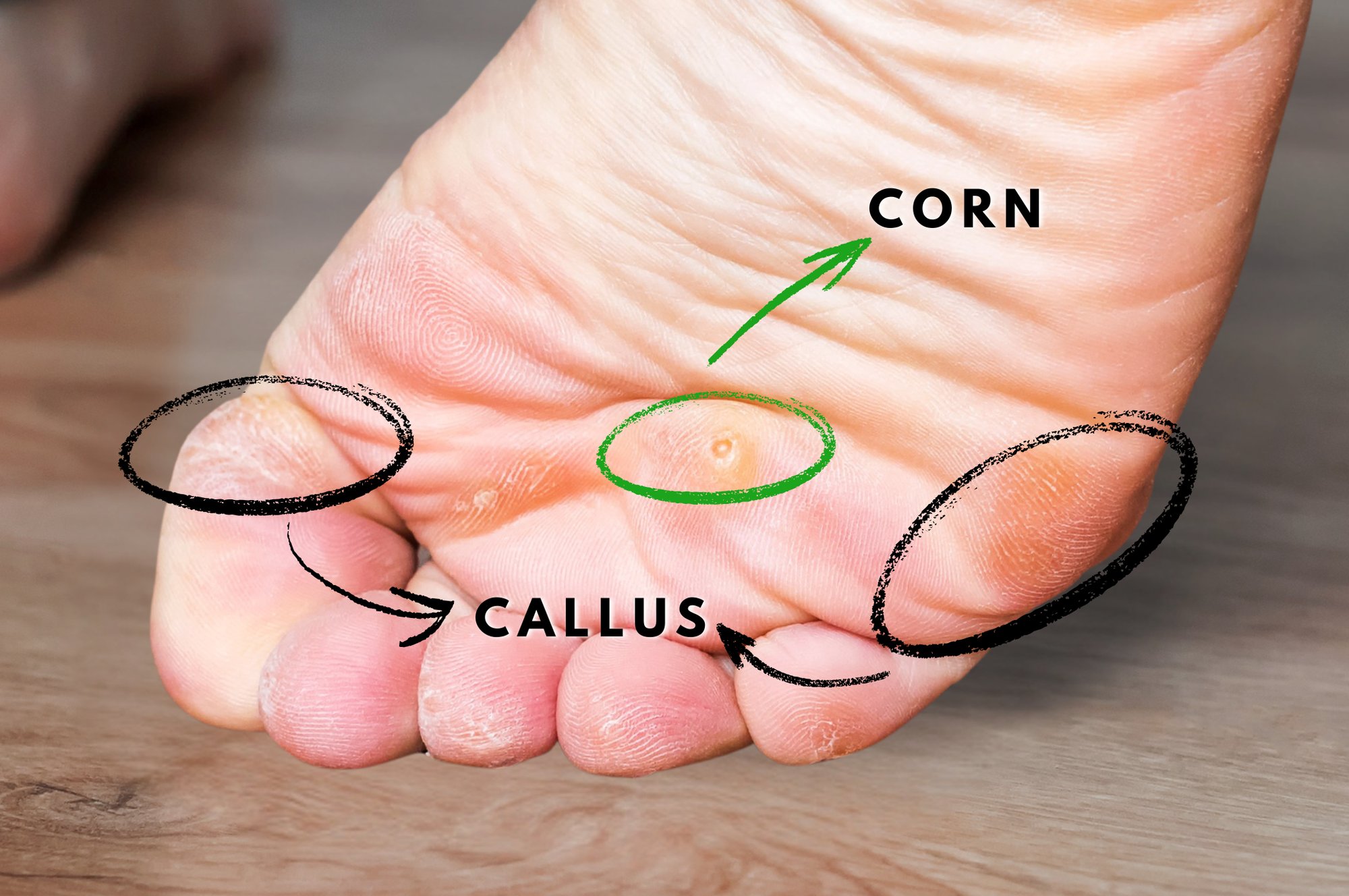 Corn & Callus (2)