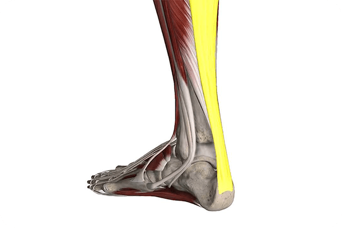 Achilles Tendonitis