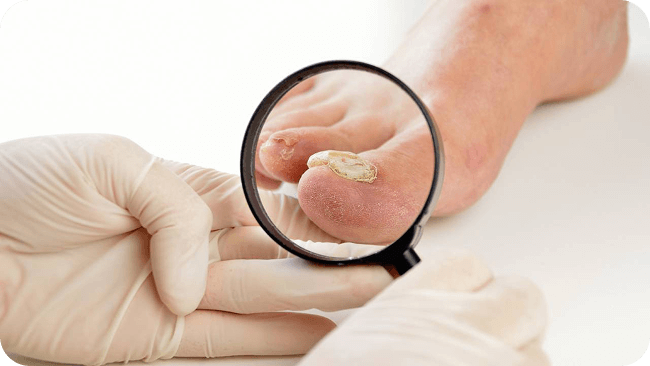 Fungal Toenail Image