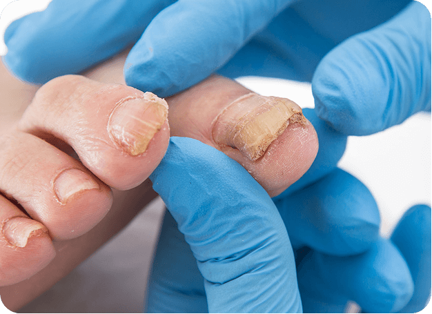 Fungal Toenail img-157