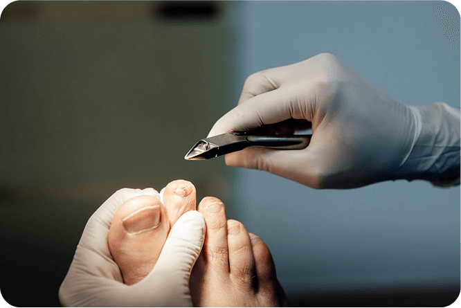 Fungal Toenail podiatry