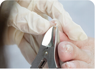 Toenail Debridement