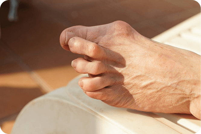 bunion-next