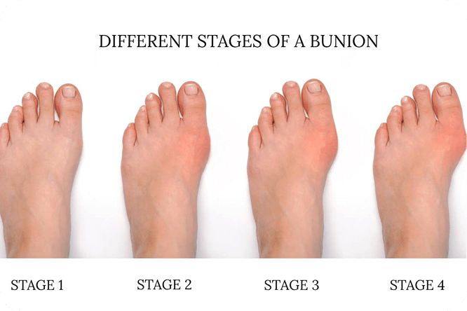 causes-of-bunion