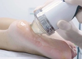 heel pain shockwave treatment