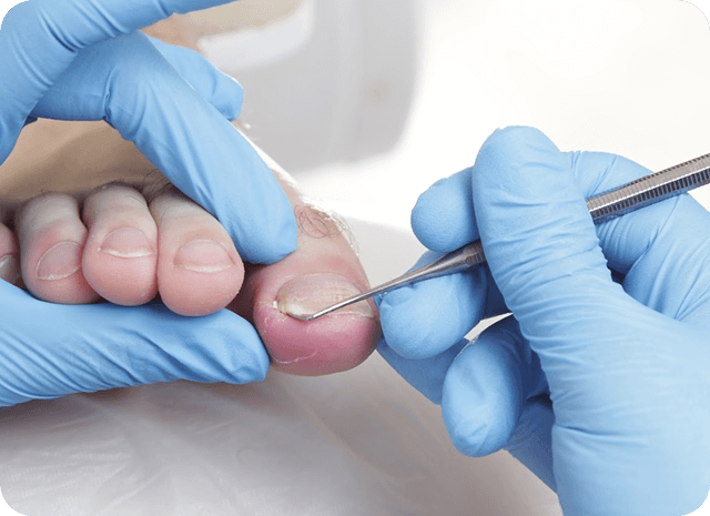 nail edge