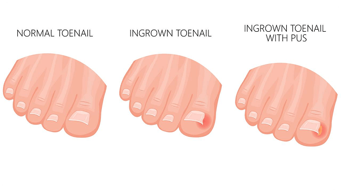 normal toenail