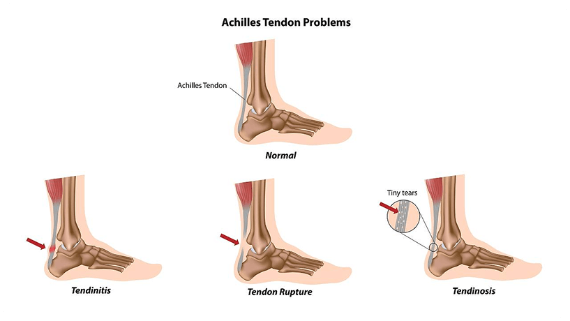 tendon pain