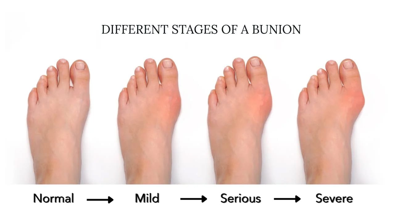 toe-bunion (1)