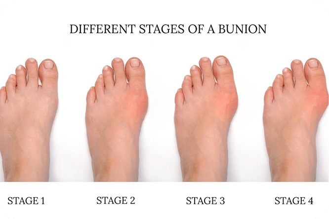 causes-of-bunion