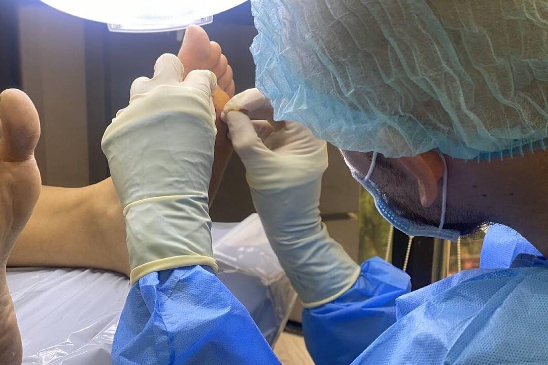 plantar-wart-removal